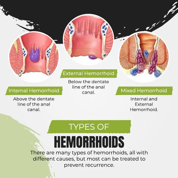 No.1 Hemorrhoids Treatment Spray