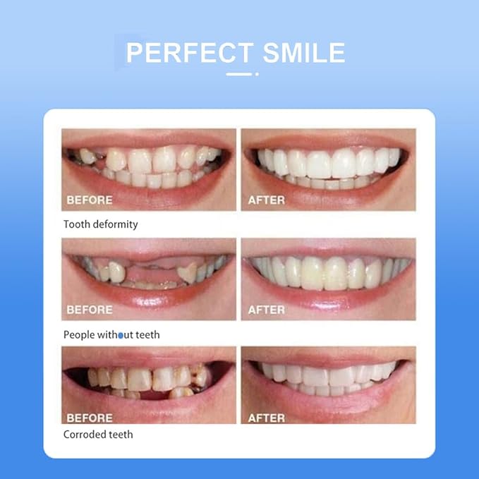 Snap On Smile Veneers Moldable False Teeth Kit for Men & Women