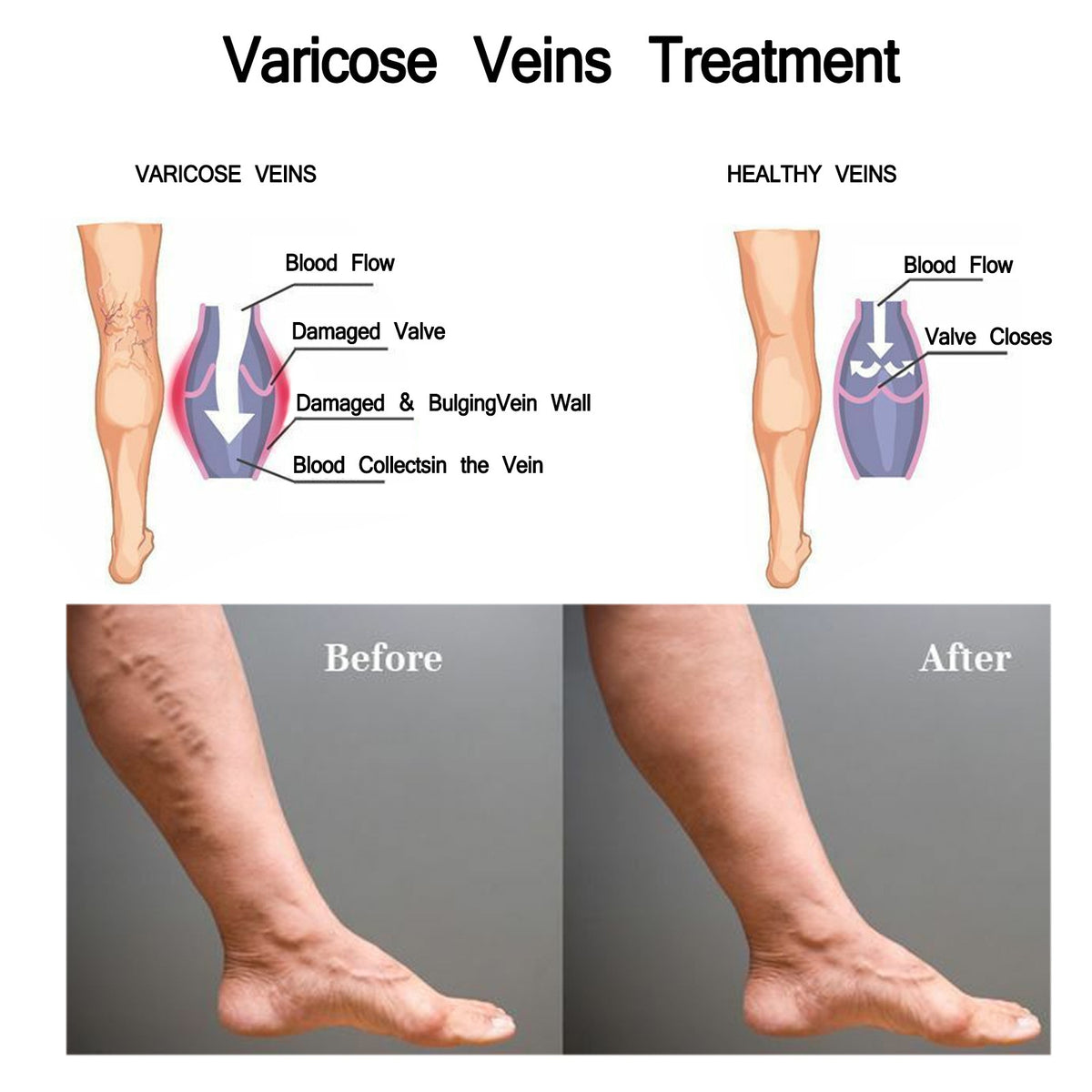 Vein Treatment Varicose Vein Treatment Spray, Leg Varicose Vein Treatment