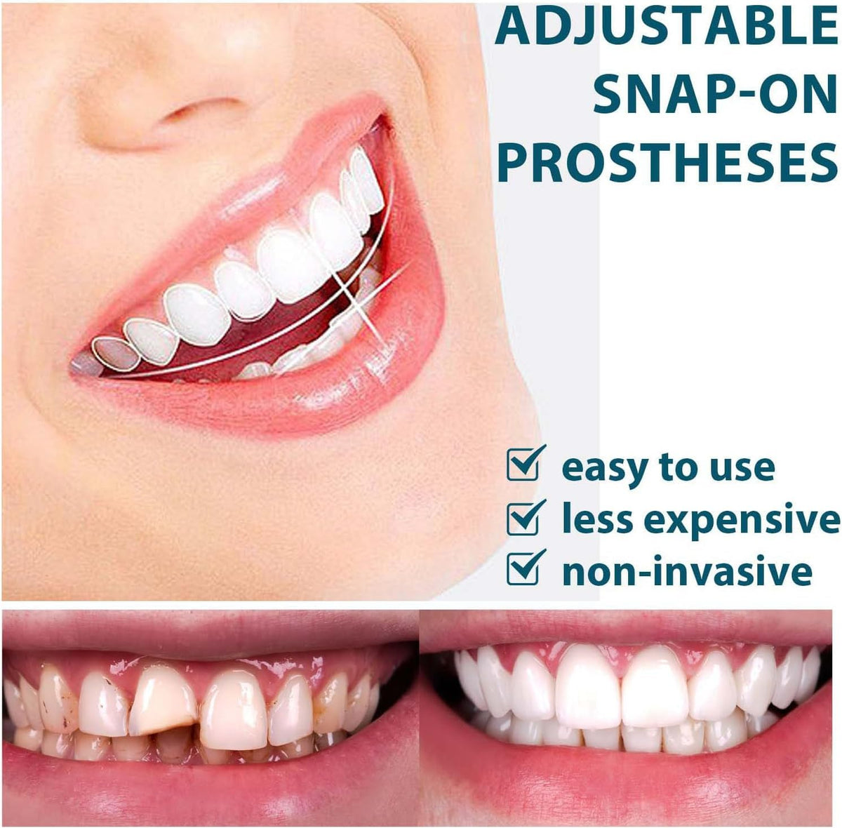 Snap On Smile Veneers Moldable False Teeth Kit for Men & Women