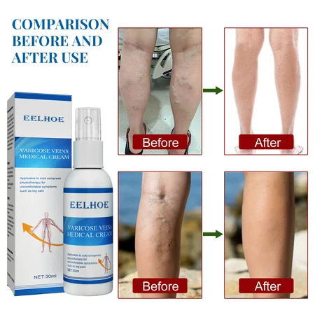 Vein Treatment Varicose Vein Treatment Spray, Leg Varicose Vein Treatment