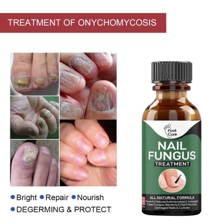 10ml Oil for Nail Fungus